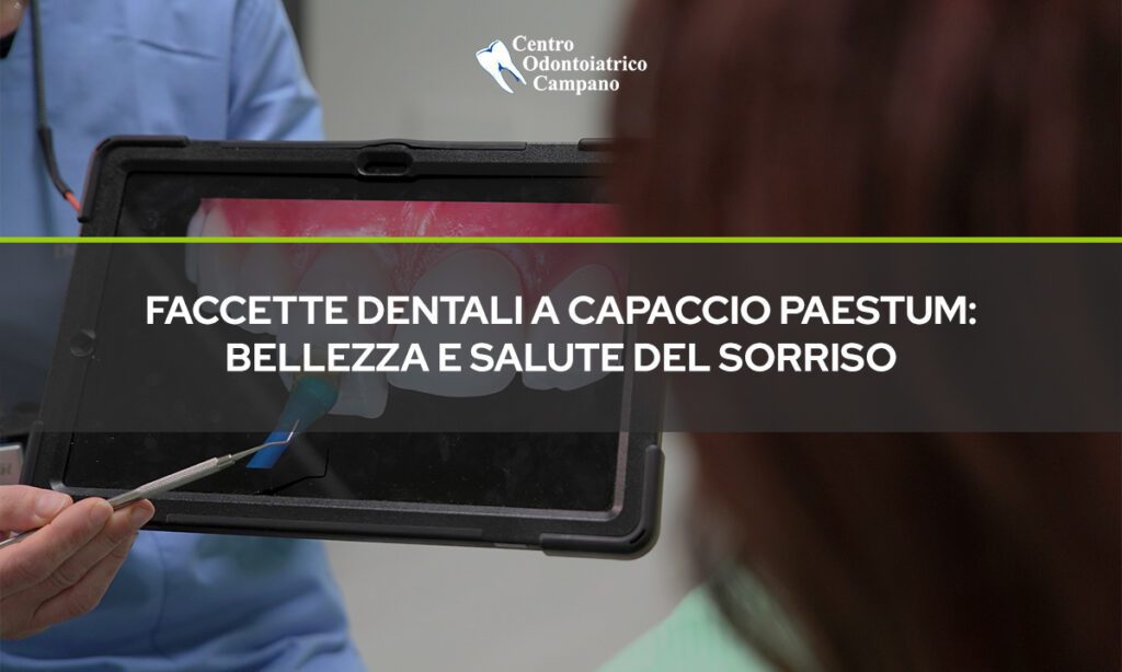 Faccette-Dentali-a-Capaccio-Paestum-Bellezza-e-Salute-del-Sorriso-Quando-e-il-Momento-Giusto-Centro-Odontoiatrico-Campano-Blog-1024x614