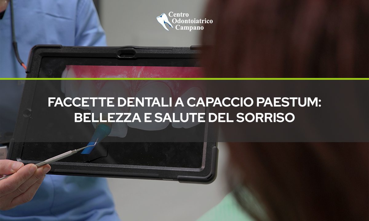 Faccette-Dentali-a-Capaccio-Paestum-Bellezza-e-Salute-del-Sorriso-Quando-e-il-Momento-Giusto-Centro-Odontoiatrico-Campano-Blog-1024x614