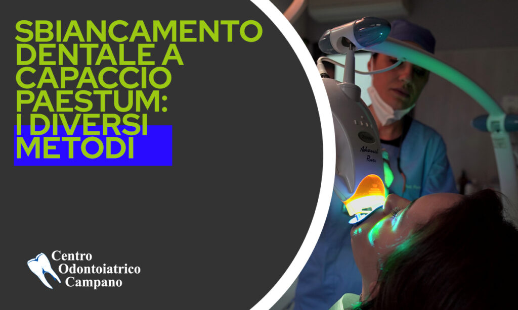 Copertina-Blog-2-Sbiancamento Dentale a Capaccio Paestum: I diversi metodi