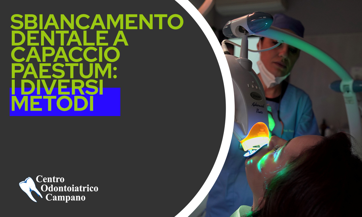 Copertina-Blog-2-Sbiancamento Dentale a Capaccio Paestum: I diversi metodi